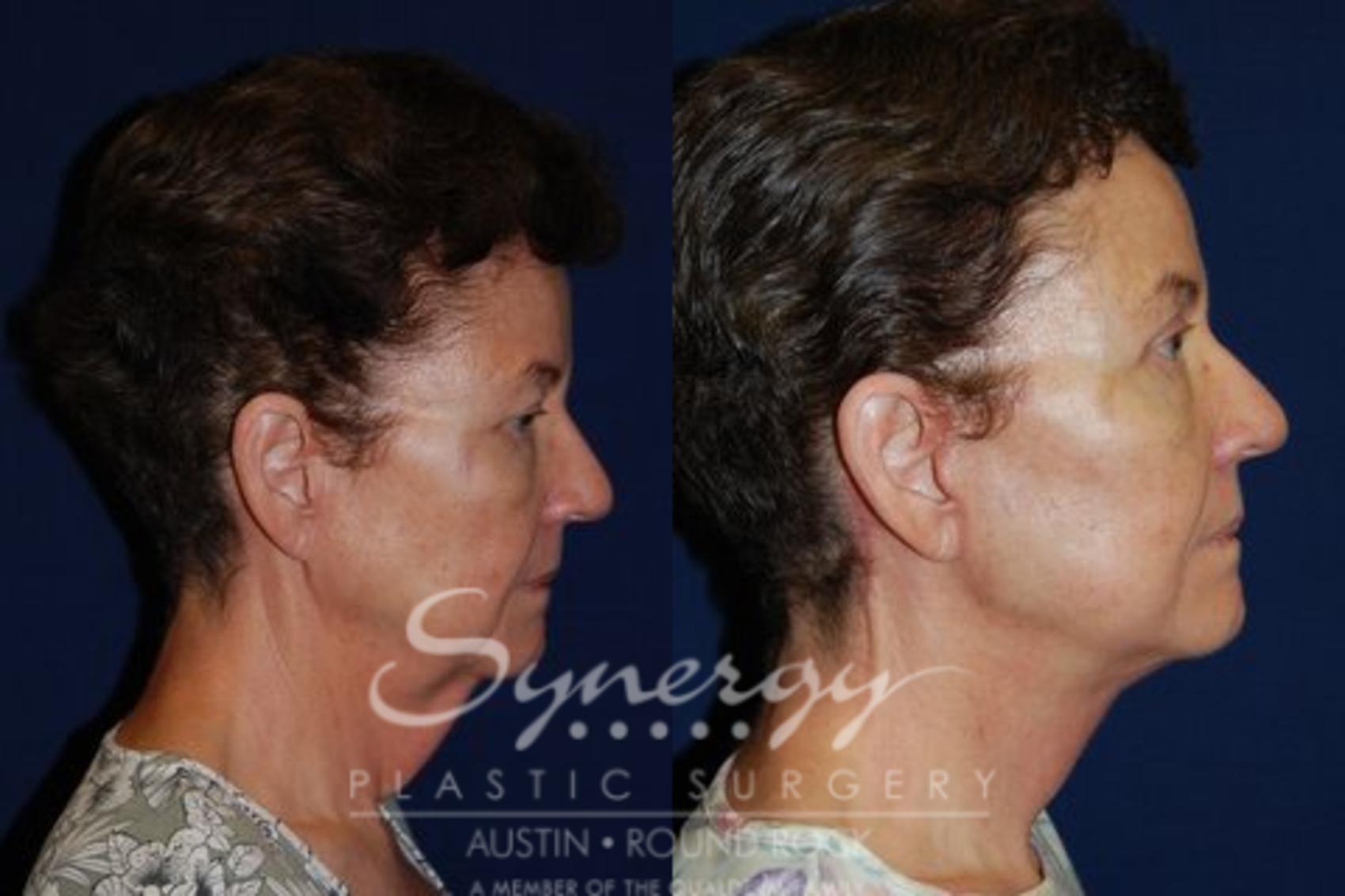 Before & After Neck Lift (Cervicoplasty) Case 74 View #1 View in Round Rock, TX