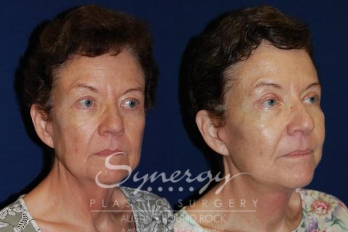 Before & After Neck Lift (Cervicoplasty) Case 74 View #2 View in Austin, TX