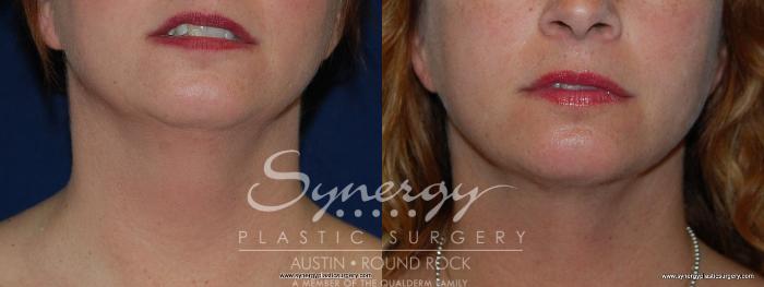 Before & After Neck Liposuction Case 159 View #2 View in Austin, TX