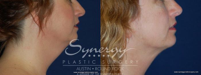 Before & After Neck Liposuction Case 159 View #3 View in Austin, TX