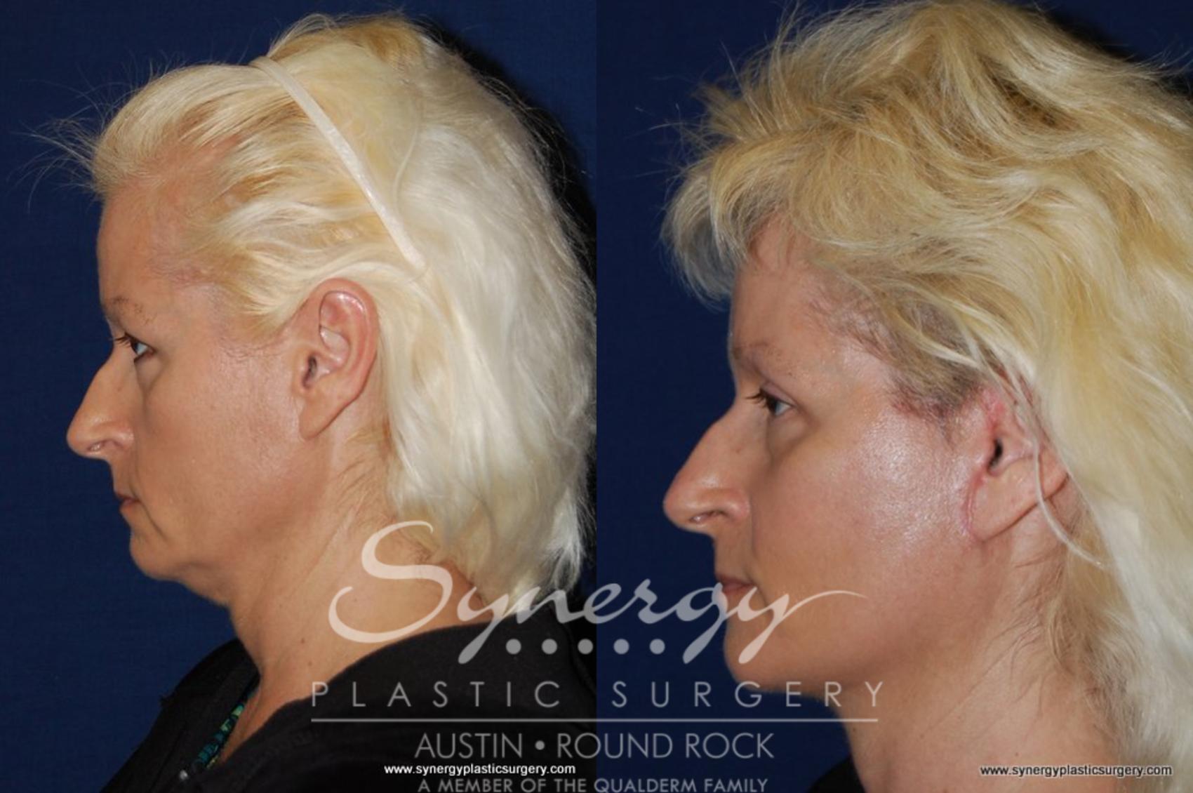 Before & After Neck Liposuction Case 194 View #2 View in Austin, TX