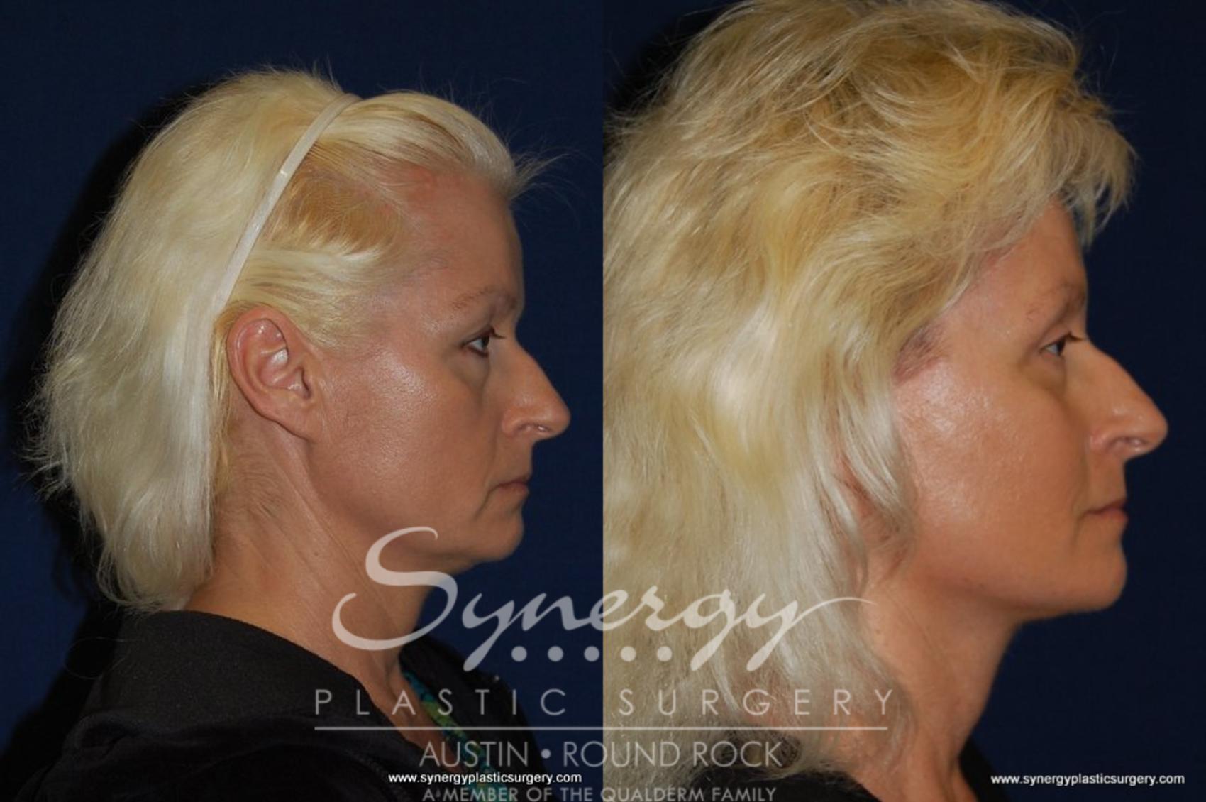 Neck Liposuction Before and After Pictures Case 194 Round Rock, TX Synergy Plastic Surgery