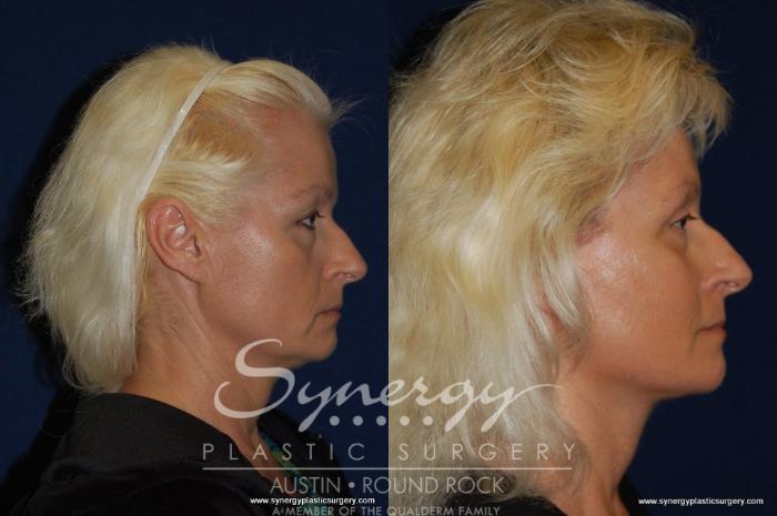 Before & After Neck Liposuction Case 194 View #3 View in Austin, TX