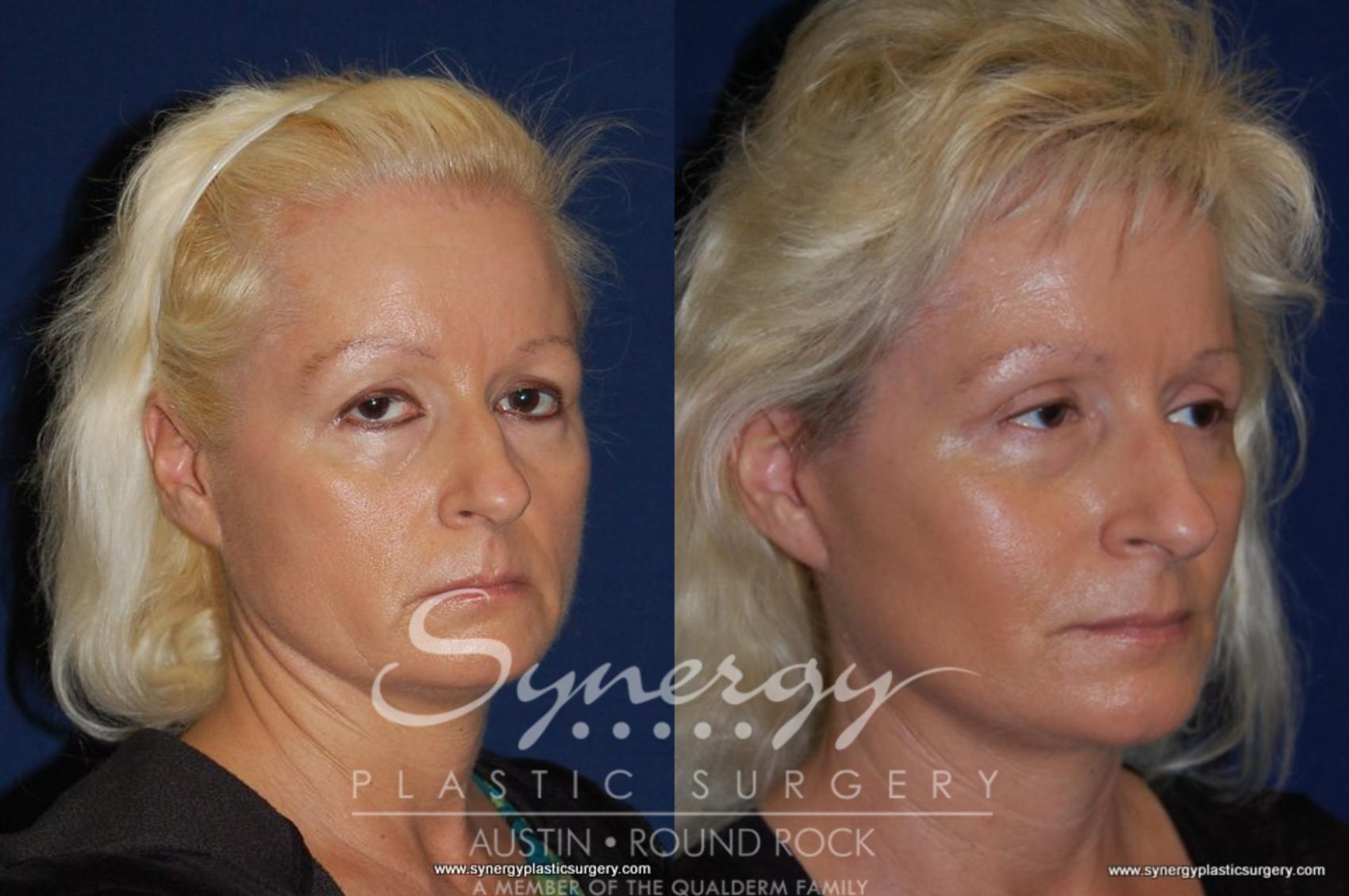 Neck Liposuction Before and After Pictures Case 194 Round Rock, TX