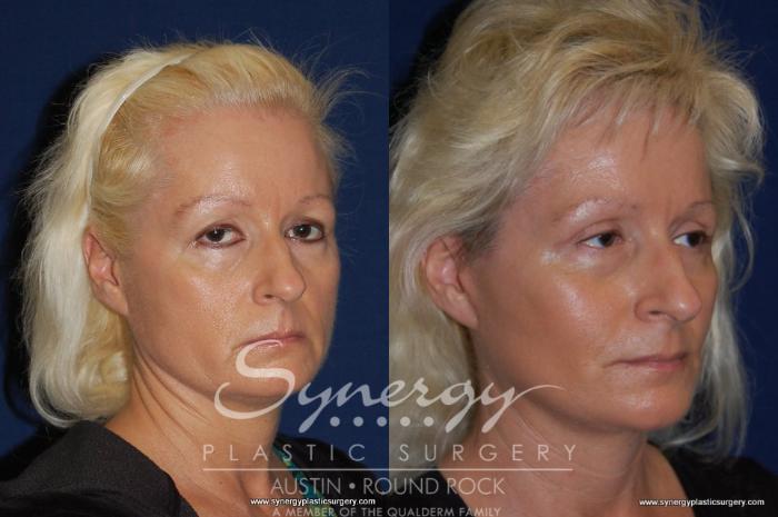 Before & After Neck Liposuction Case 194 View #4 View in Austin, TX