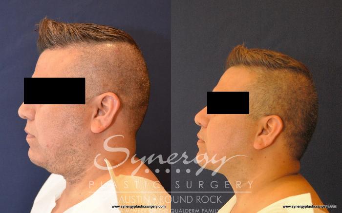 Before & After Neck Liposuction Case 524 View #1 View in Austin, TX