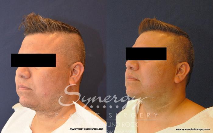 Before & After Neck Liposuction Case 524 View #2 View in Austin, TX