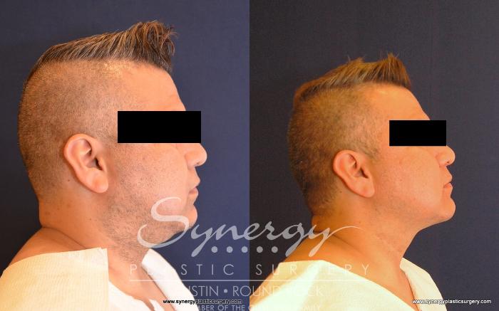 Before & After Neck Liposuction Case 524 View #3 View in Austin, TX