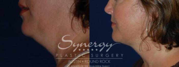 Before & After Neck Liposuction Case 68 View #2 View in Austin, TX