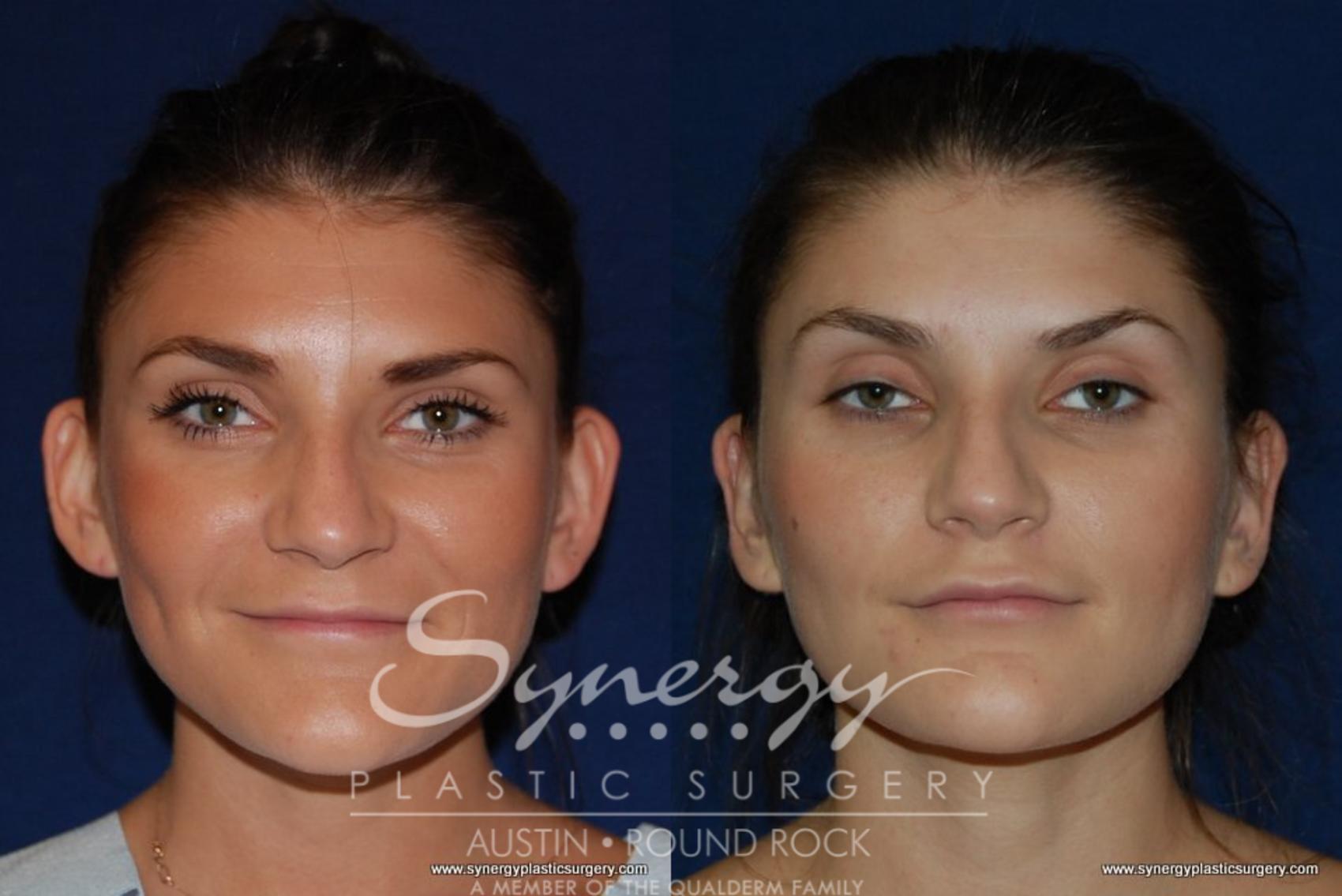 Before & After Otoplasty (Pin Back Ears) Case 175 View #1 View in Round Rock, TX