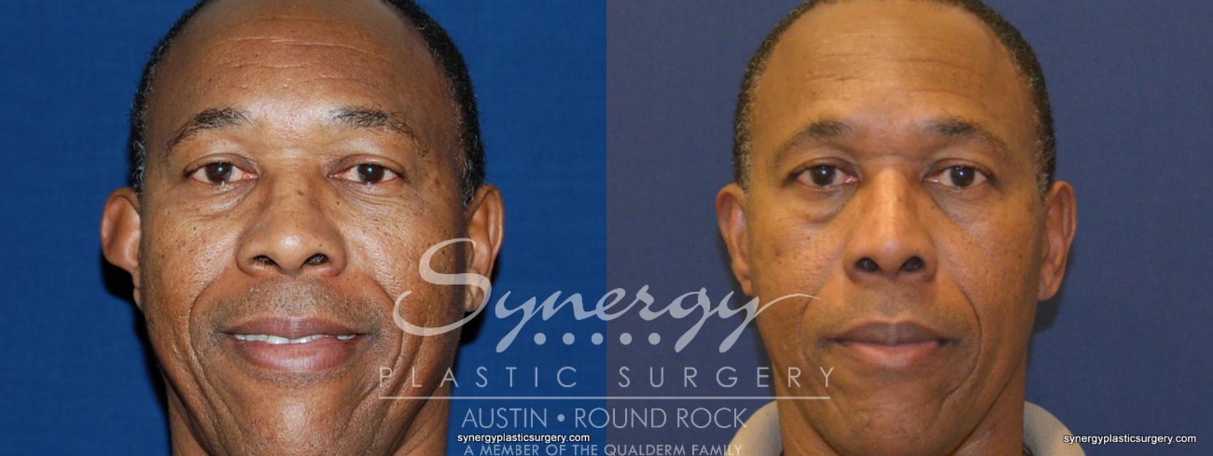 Before & After Otoplasty (Pin Back Ears) Case 252 View #1 View in Austin, TX