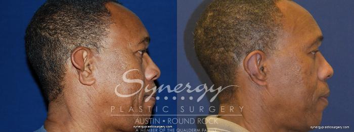 Before & After Otoplasty (Pin Back Ears) Case 252 View #2 View in Austin, TX