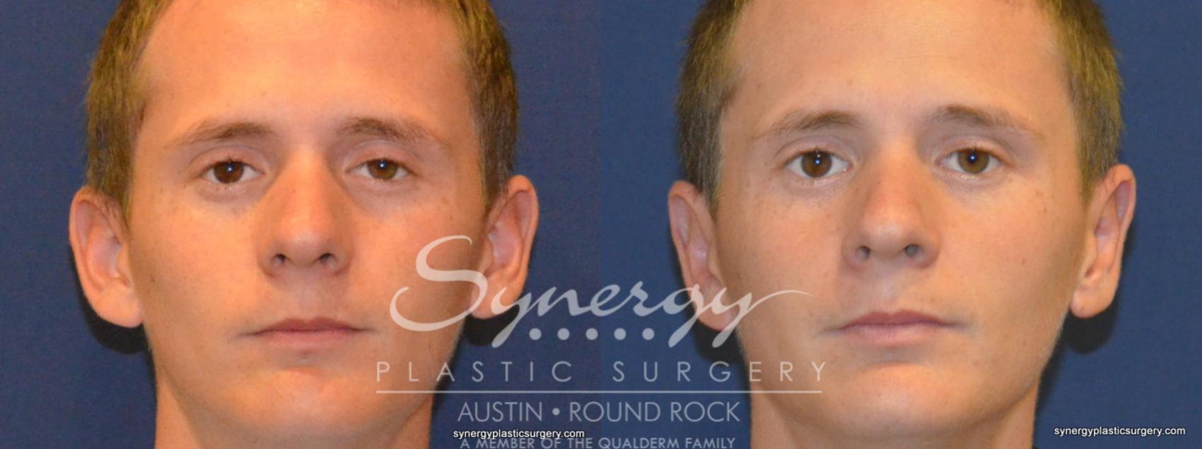 Before & After Otoplasty (Pin Back Ears) Case 253 View #1 View in Austin, TX