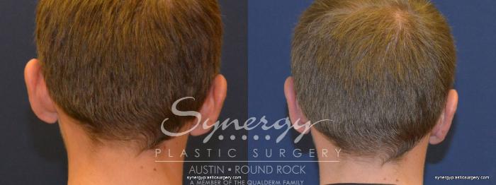 Before & After Otoplasty (Pin Back Ears) Case 253 View #2 View in Austin, TX
