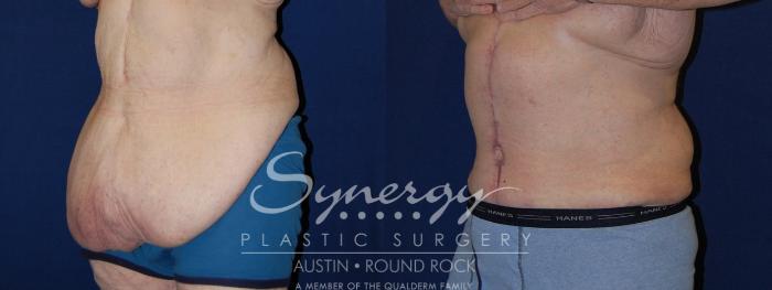 Before & After Post Weight Loss Surgery Case 118 View #2 View in Austin, TX