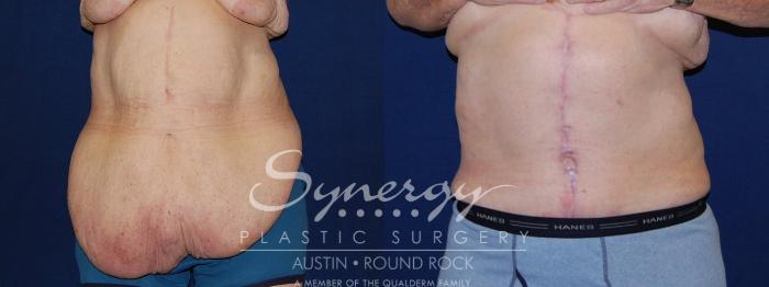Before & After Post Weight Loss Surgery Case 118 View #3 View in Austin, TX