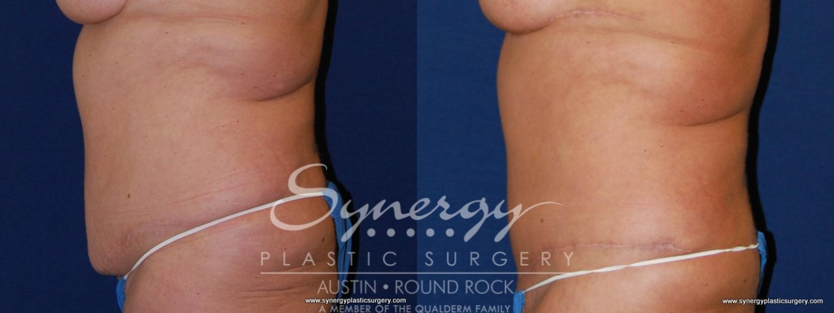 Before & After Post Weight Loss Surgery Case 173 View #1 View in Austin, TX