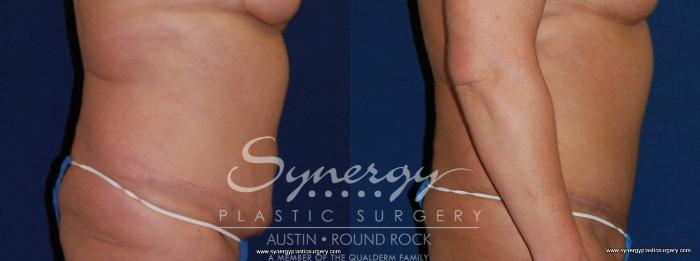 Before & After Post Weight Loss Surgery Case 173 View #2 View in Austin, TX