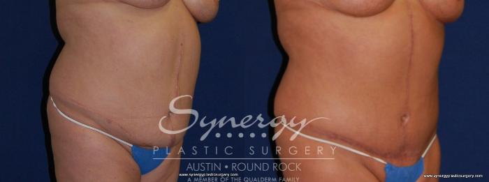 Before & After Post Weight Loss Surgery Case 173 View #3 View in Austin, TX