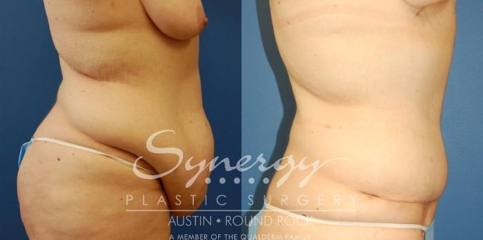 Before & After Post Weight Loss Surgery Case 31 View #2 View in Austin, TX