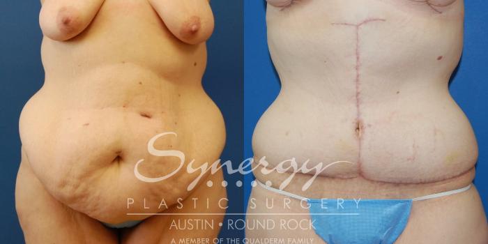 Before & After Post Weight Loss Surgery Case 31 View #3 View in Austin, TX