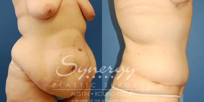 Before & After Post Weight Loss Surgery Case 31 View #4 View in Austin, TX