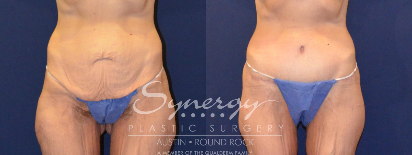 Before & After Post Weight Loss Surgery Case 316 View #1 View in Round Rock, TX