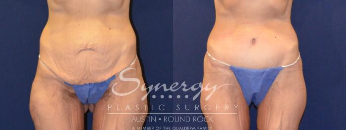 Before & After Post Weight Loss Surgery Case 316 View #1 View in Austin, TX