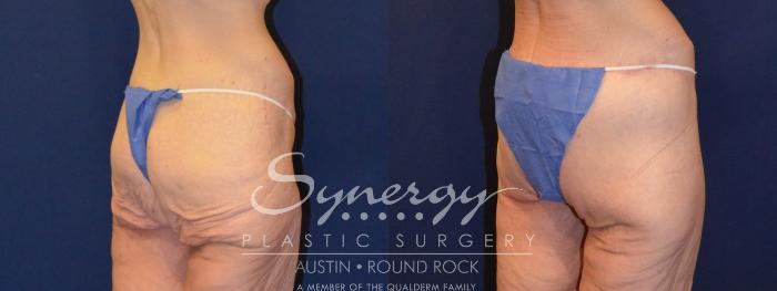 Before & After Post Weight Loss Surgery Case 316 View #3 View in Austin, TX