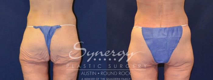 Before & After Post Weight Loss Surgery Case 316 View #4 View in Austin, TX