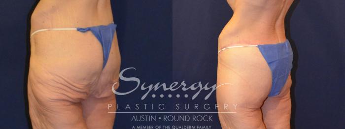 Before & After Post Weight Loss Surgery Case 316 View #5 View in Austin, TX