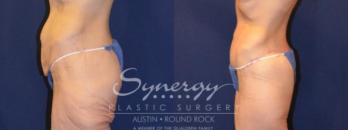 Before & After Post Weight Loss Surgery Case 316 View #6 View in Austin, TX