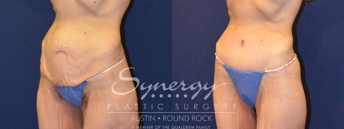Before & After Post Weight Loss Surgery Case 316 View #7 View in Austin, TX