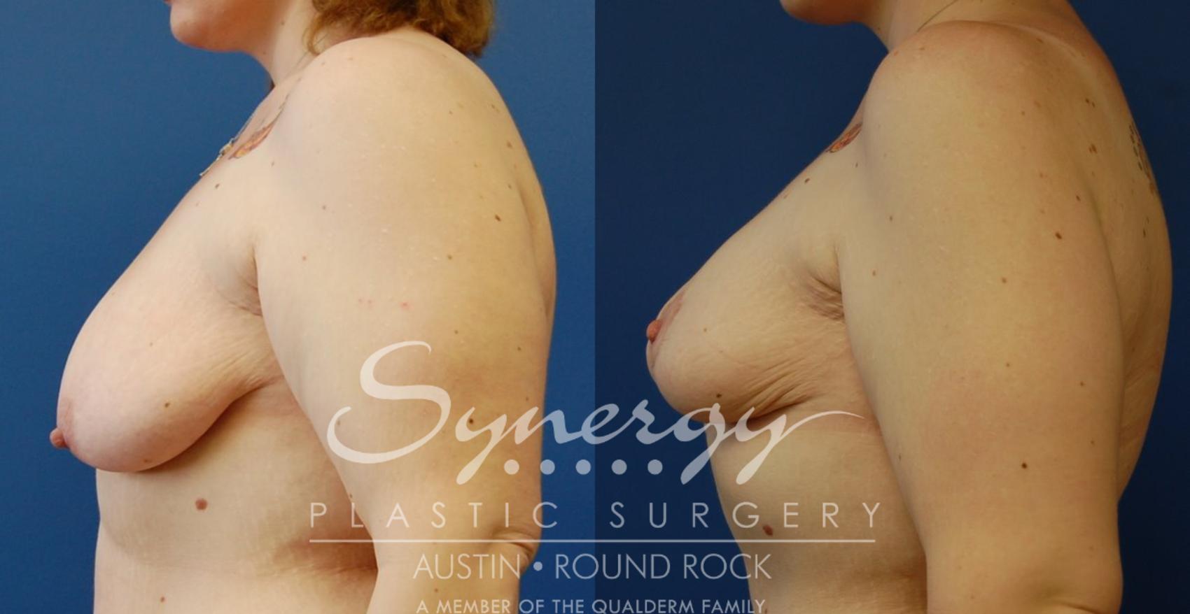 Post Weight Loss Surgery Before and After Pictures Case 37