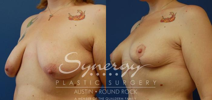 Before & After Post Weight Loss Surgery Case 37 View #2 View in Austin, TX