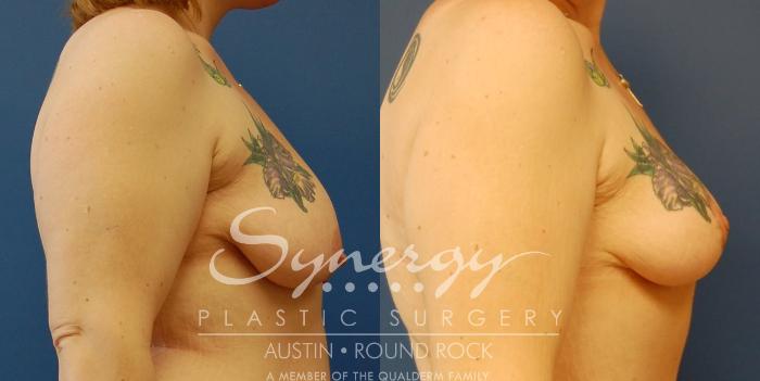 Before & After Post Weight Loss Surgery Case 37 View #3 View in Austin, TX