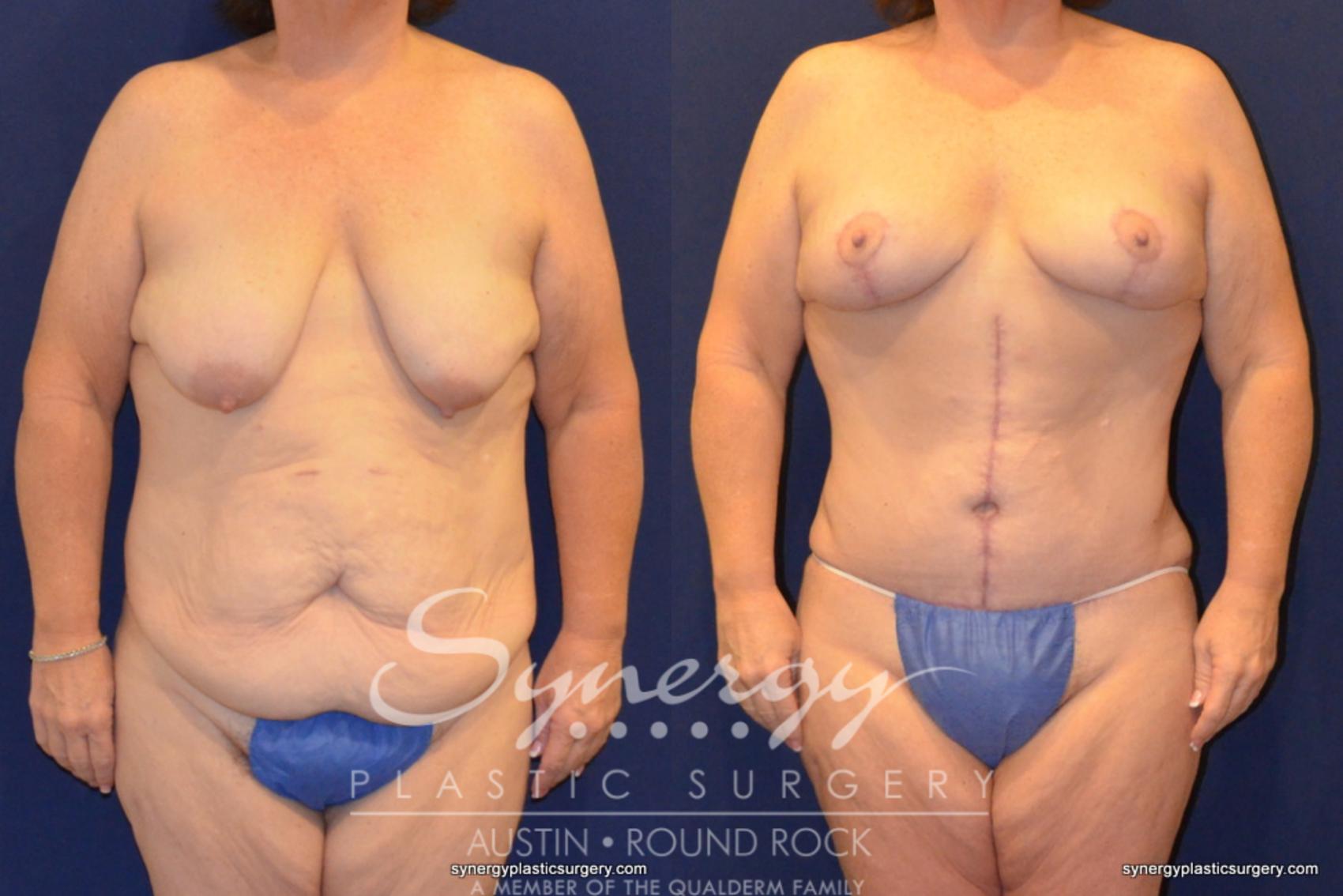 Before & After Post Weight Loss Surgery Case 399 View #1 View in Round Rock, TX