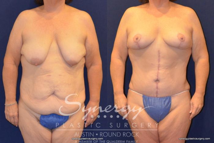 Before & After Fleur-de-Lis Tummy Tuck Case 399 View #1 View in Austin, TX