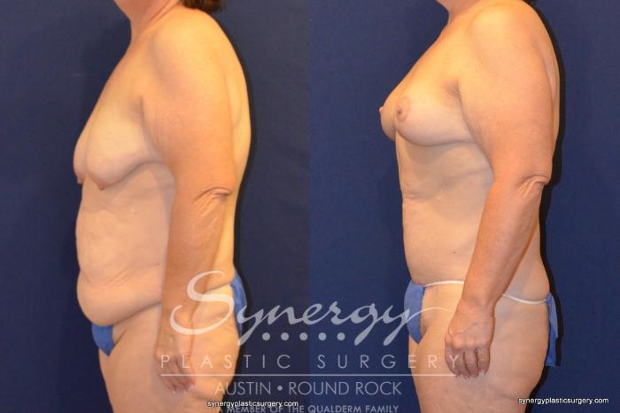 Before & After Fleur-de-Lis Tummy Tuck Case 399 View #2 View in Austin, TX
