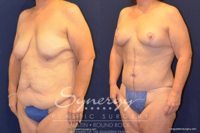Before & After Post Weight Loss Surgery Case 399 View #3 View in Austin, TX