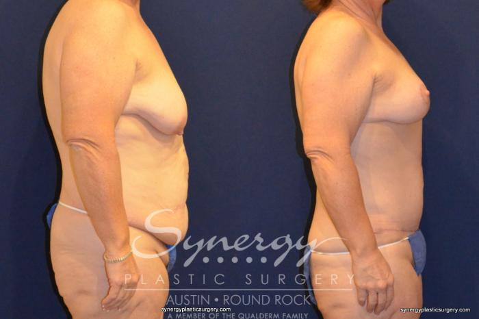 Before & After Post Weight Loss Surgery Case 399 View #4 View in Austin, TX