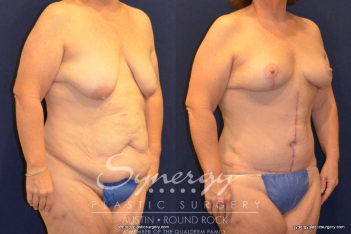 Before & After Fleur-de-Lis Tummy Tuck Case 399 View #5 View in Austin, TX
