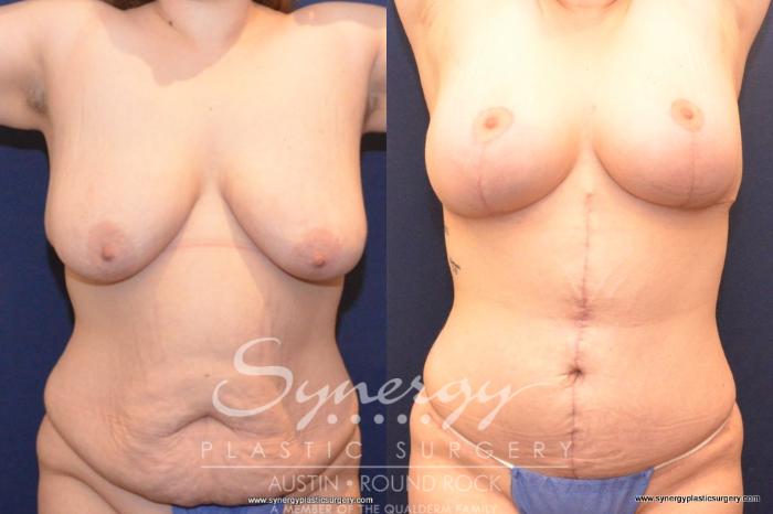 Before & After Post Weight Loss Surgery Case 414 View #1 View in Austin, TX