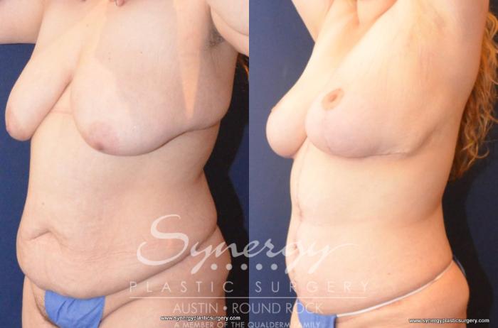 Before & After Post Weight Loss Surgery Case 414 View #2 View in Austin, TX