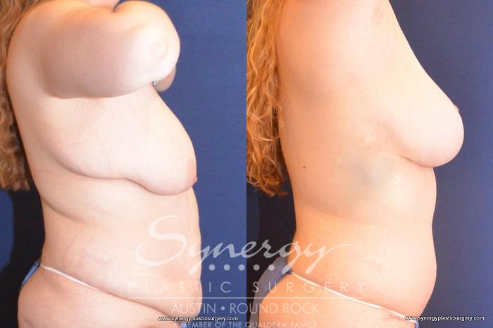 Before & After Post Weight Loss Surgery Case 414 View #3 View in Austin, TX