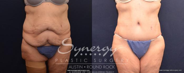 Before & After Post Weight Loss Surgery Case 499 View #1 View in Austin, TX