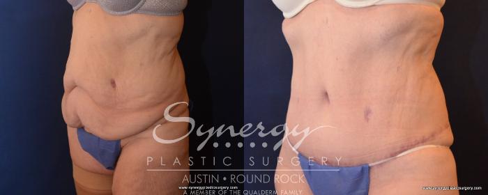Before & After Post Weight Loss Surgery Case 499 View #5 View in Austin, TX