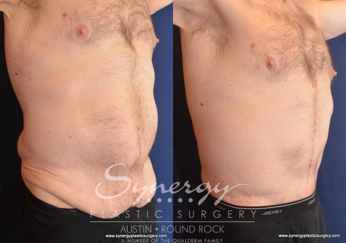 Post Weight Loss Surgery Before and After Pictures Case 599, Austin, TX