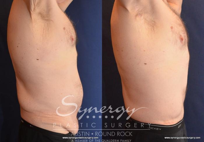 Before & After Post Weight Loss Surgery Case 599 View #3 View in Austin, TX