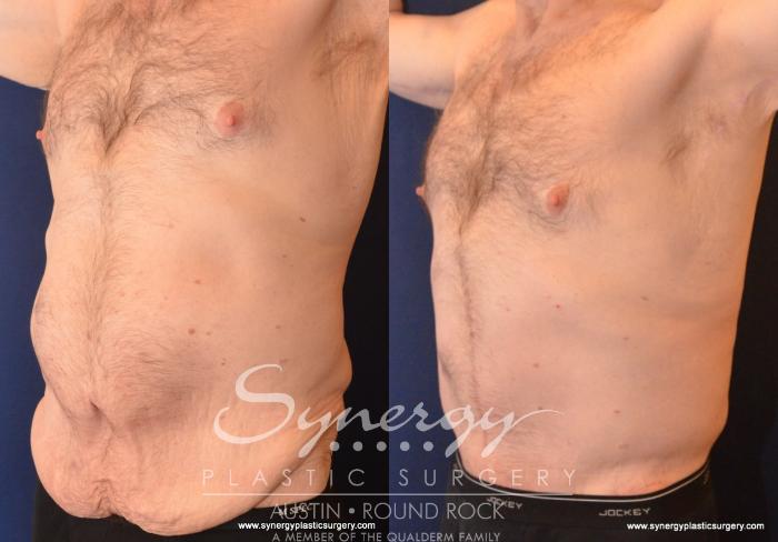 Before & After Post Weight Loss Surgery Case 599 View #4 View in Austin, TX